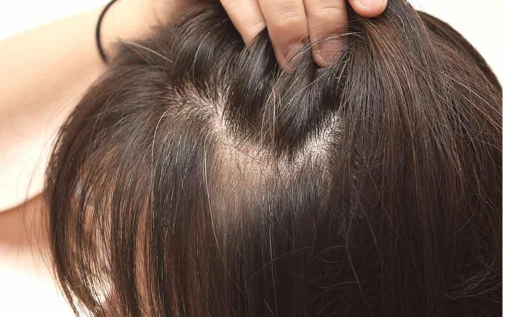 نحوه درمان موهای شکننده و نازک به جز کراتینه مو